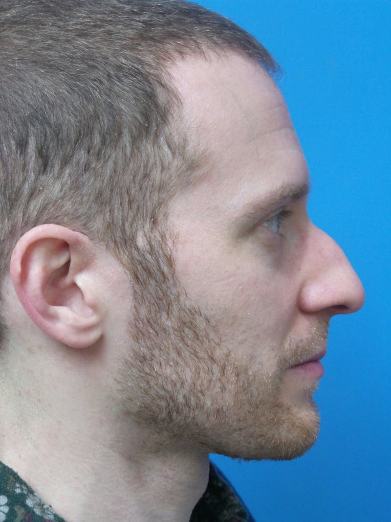 Rhinoplasty Before & After Gallery - Patient 276987 - Image 1