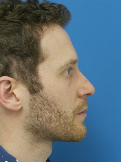 Rhinoplasty Before & After Gallery - Patient 276987 - Image 2