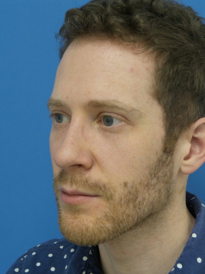 Rhinoplasty Before & After Gallery - Patient 276987 - Image 4