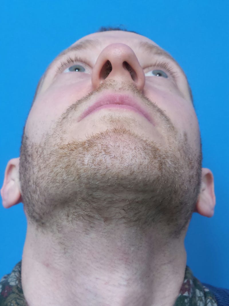 Rhinoplasty Before & After Gallery - Patient 276987 - Image 7