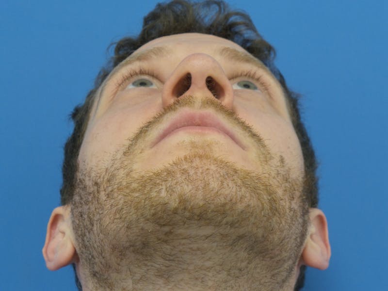 Rhinoplasty Before & After Gallery - Patient 276987 - Image 8