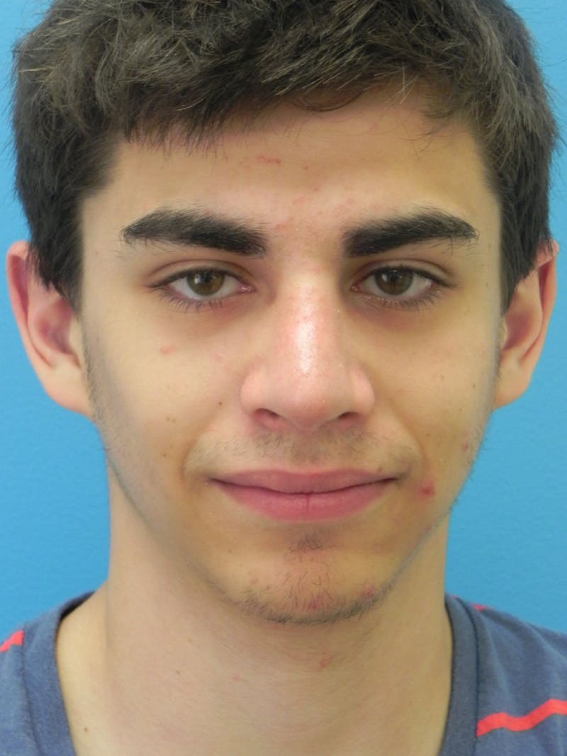 Rhinoplasty Before & After Gallery - Patient 423216 - Image 3
