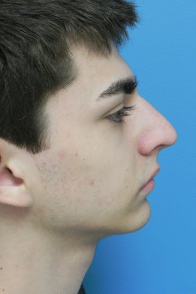 Rhinoplasty Before & After Gallery - Patient 423216 - Image 2