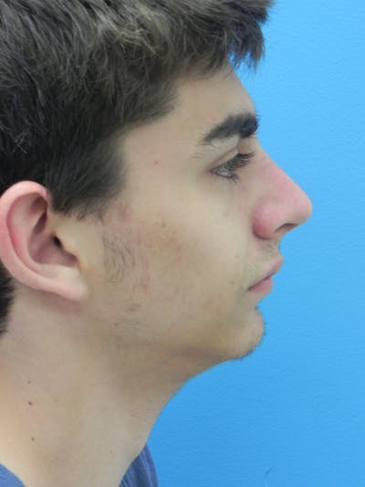 Rhinoplasty Before & After Gallery - Patient 423216 - Image 1