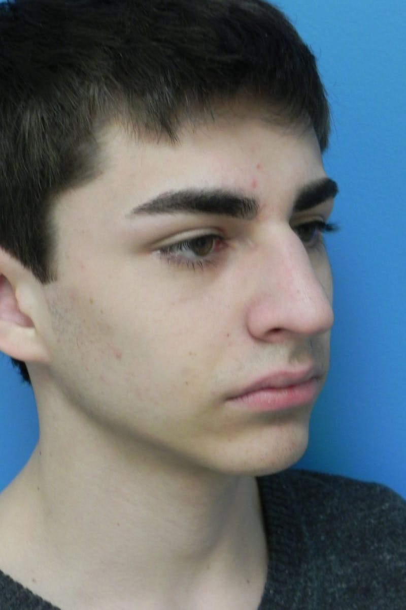 Rhinoplasty Before & After Gallery - Patient 423216 - Image 6
