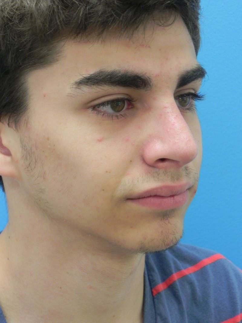 Rhinoplasty Before & After Gallery - Patient 423216 - Image 5