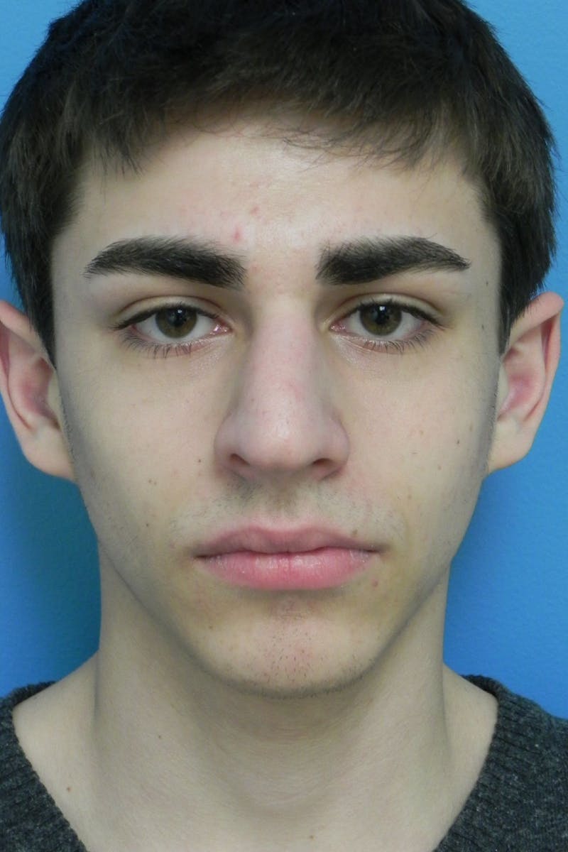 Rhinoplasty Before & After Gallery - Patient 423216 - Image 4
