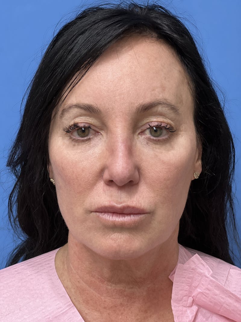 Rhinoplasty Before & After Gallery - Patient 407037 - Image 4