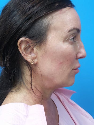 Rhinoplasty Before & After Gallery - Patient 407037 - Image 1