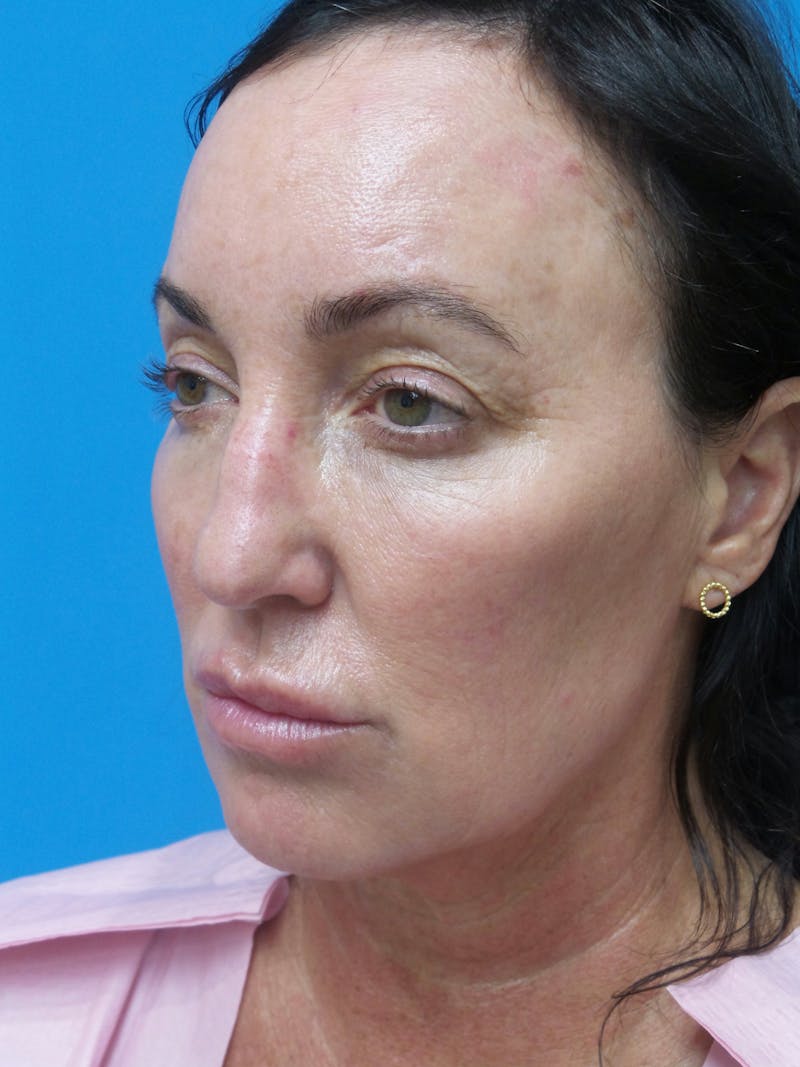 Rhinoplasty Before & After Gallery - Patient 407037 - Image 5