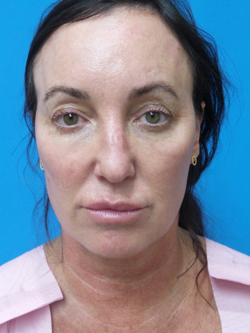 Rhinoplasty Before & After Gallery - Patient 407037 - Image 3