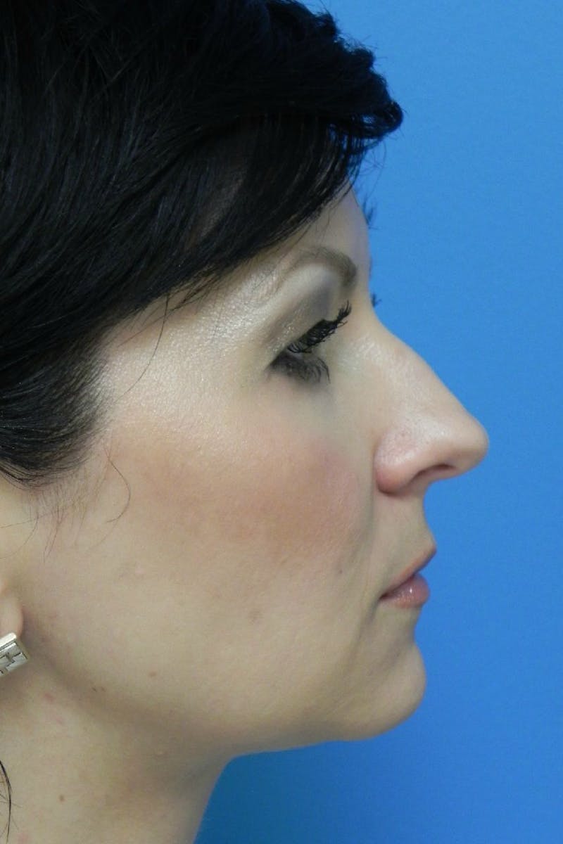 Rhinoplasty Before & After Gallery - Patient 256871 - Image 1