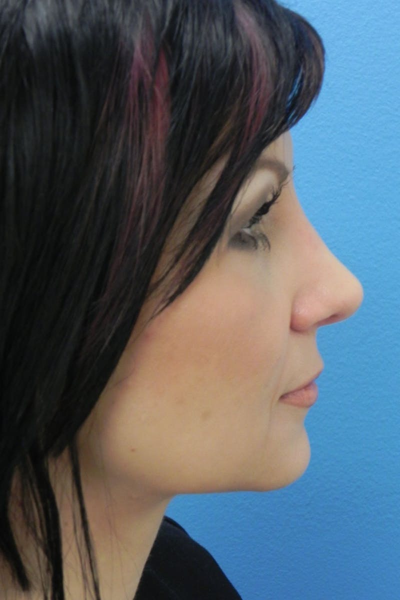 Rhinoplasty Before & After Gallery - Patient 256871 - Image 2