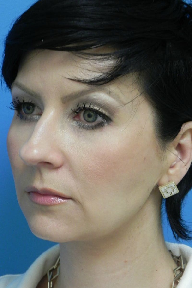 Rhinoplasty Before & After Gallery - Patient 256871 - Image 3