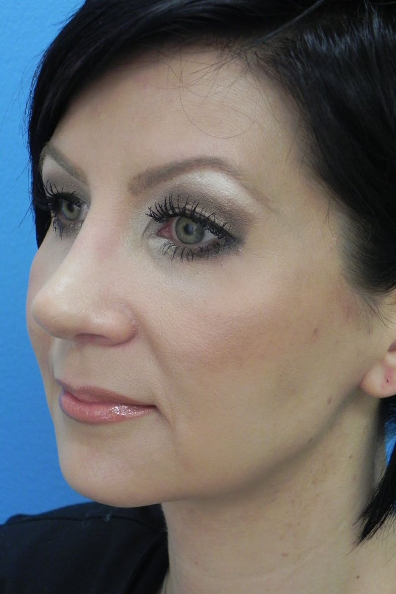 Rhinoplasty Before & After Gallery - Patient 256871 - Image 4