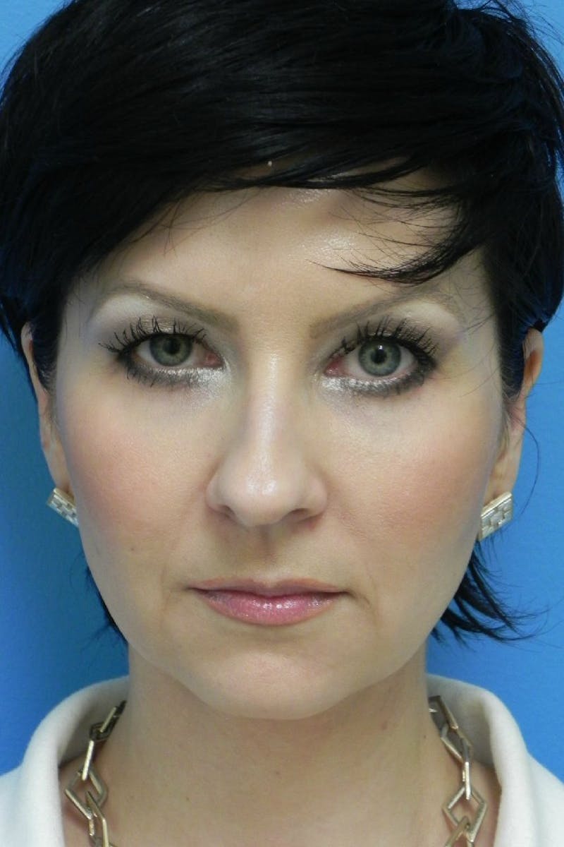 Rhinoplasty Before & After Gallery - Patient 256871 - Image 5