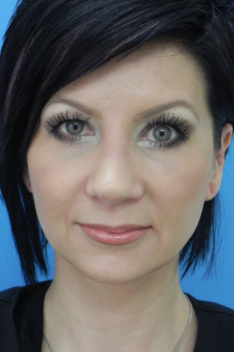 Rhinoplasty Before & After Gallery - Patient 256871 - Image 6