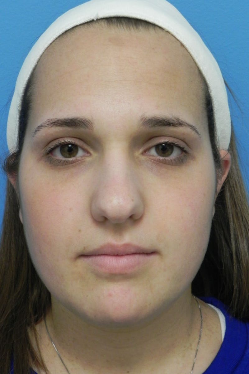Rhinoplasty Before & After Gallery - Patient 287961 - Image 3