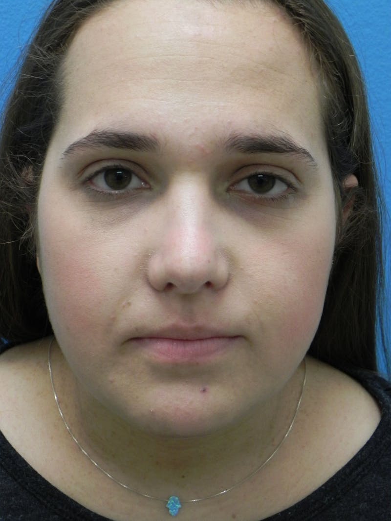 Rhinoplasty Before & After Gallery - Patient 287961 - Image 4
