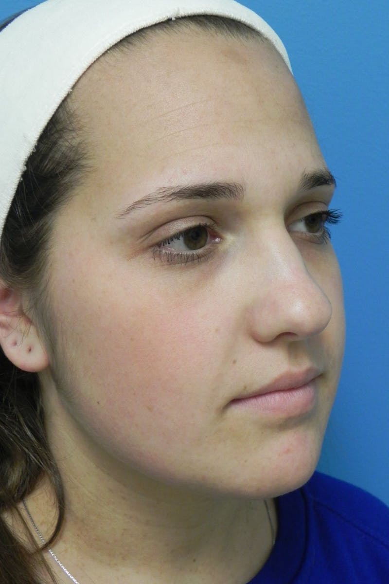 Rhinoplasty Before & After Gallery - Patient 287961 - Image 5