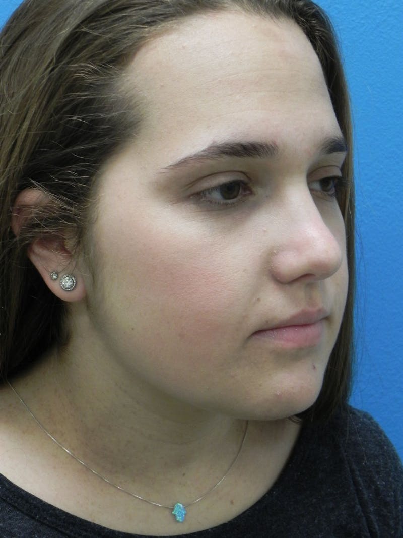 Rhinoplasty Before & After Gallery - Patient 287961 - Image 6