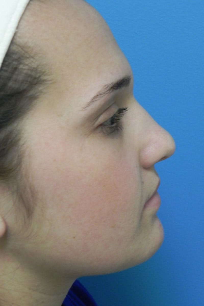 Rhinoplasty Before & After Gallery - Patient 287961 - Image 1