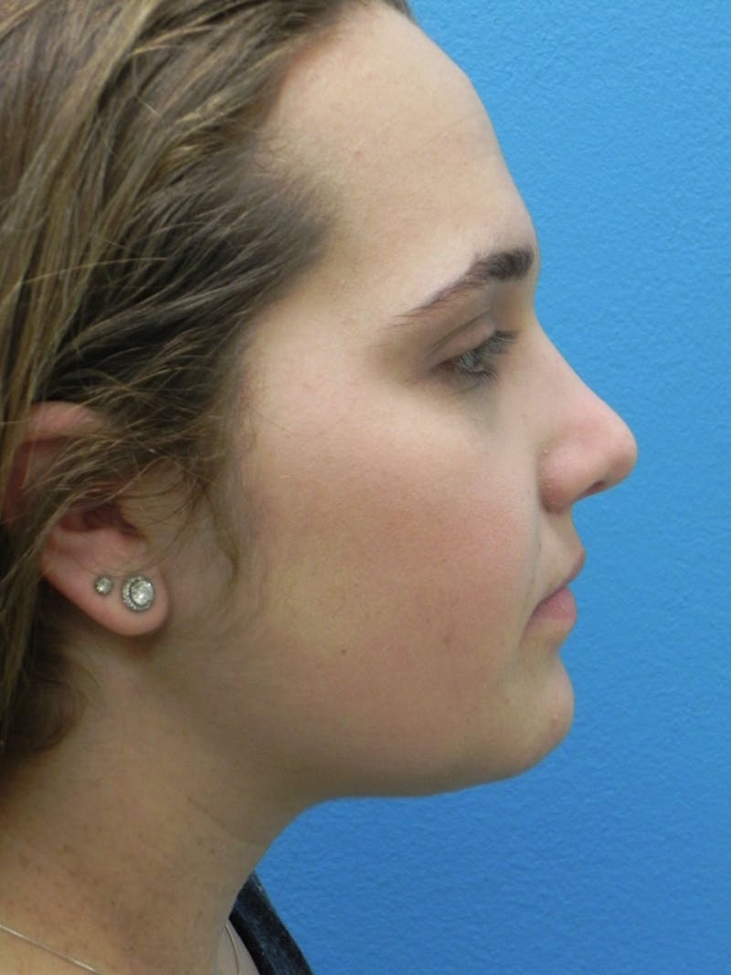 Rhinoplasty Before & After Gallery - Patient 287961 - Image 2