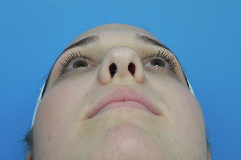Rhinoplasty Before & After Gallery - Patient 287961 - Image 7