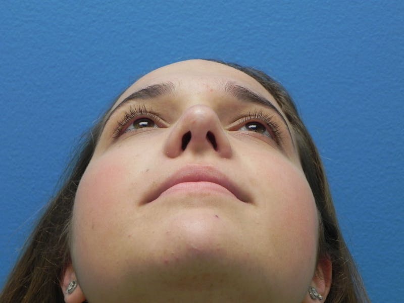 Rhinoplasty Before & After Gallery - Patient 287961 - Image 8