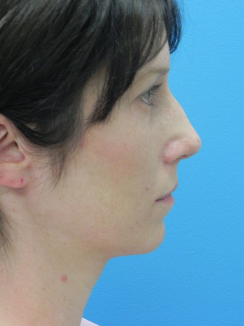 Rhinoplasty Before & After Gallery - Patient 727777 - Image 1
