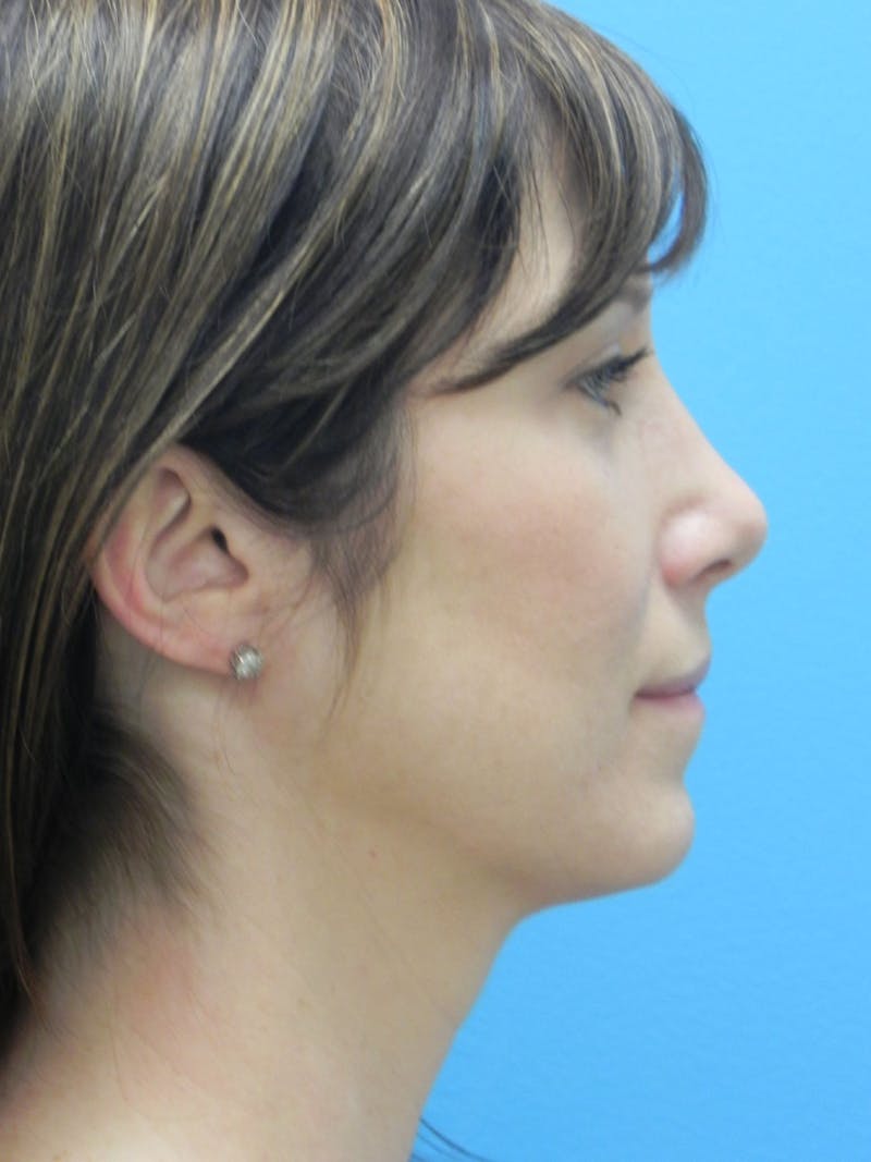 Rhinoplasty Before & After Gallery - Patient 727777 - Image 2