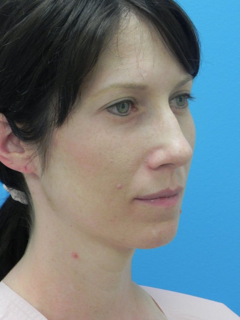 Rhinoplasty Before & After Gallery - Patient 727777 - Image 3