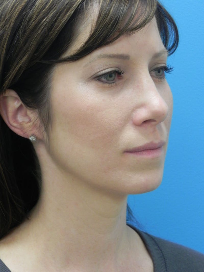 Rhinoplasty Before & After Gallery - Patient 727777 - Image 4