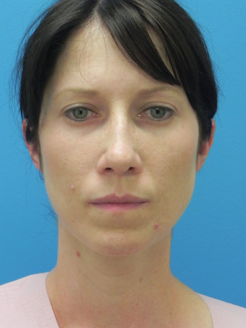 Rhinoplasty Before & After Gallery - Patient 727777 - Image 5