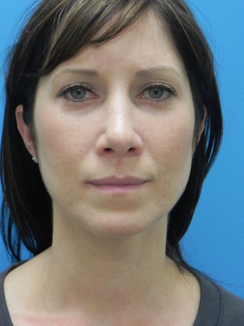 Rhinoplasty Before & After Gallery - Patient 727777 - Image 6