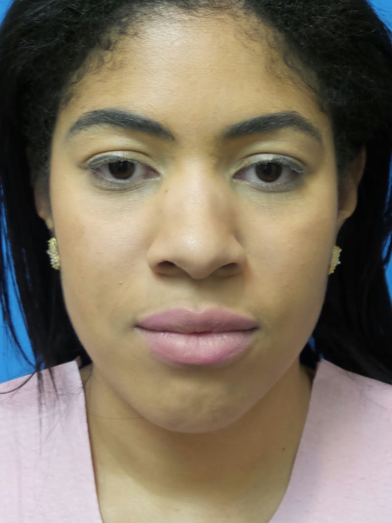 Rhinoplasty Before & After Gallery - Patient 975446 - Image 3