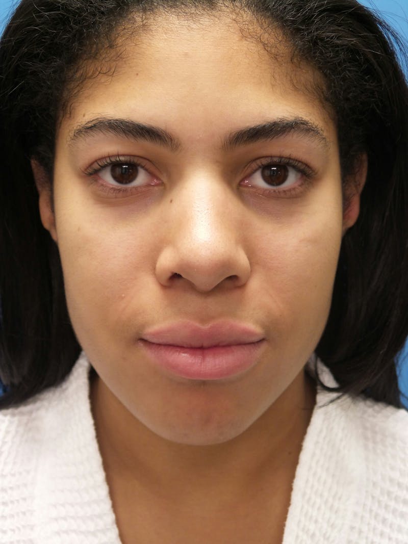 Rhinoplasty Before & After Gallery - Patient 975446 - Image 4