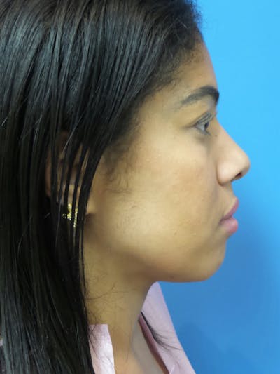 Rhinoplasty Before & After Gallery - Patient 975446 - Image 1