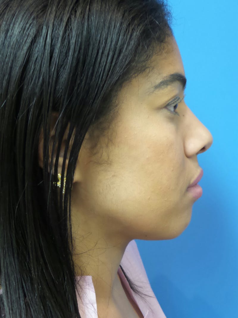 Rhinoplasty Before & After Gallery - Patient 975446 - Image 1