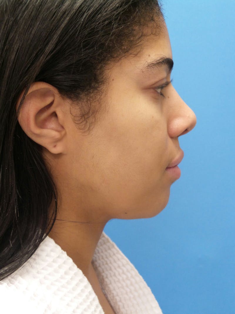 Rhinoplasty Before & After Gallery - Patient 975446 - Image 2