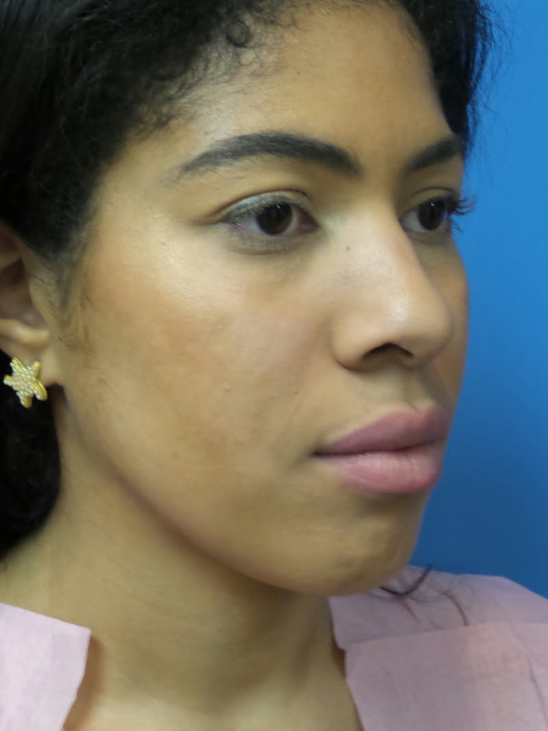 Rhinoplasty Before & After Gallery - Patient 975446 - Image 5