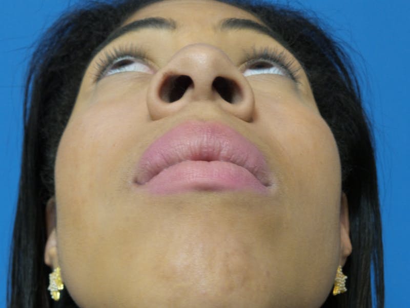 Rhinoplasty Before & After Gallery - Patient 975446 - Image 7