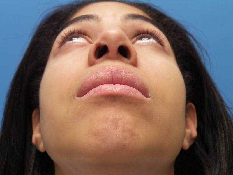 Rhinoplasty Before & After Gallery - Patient 975446 - Image 8
