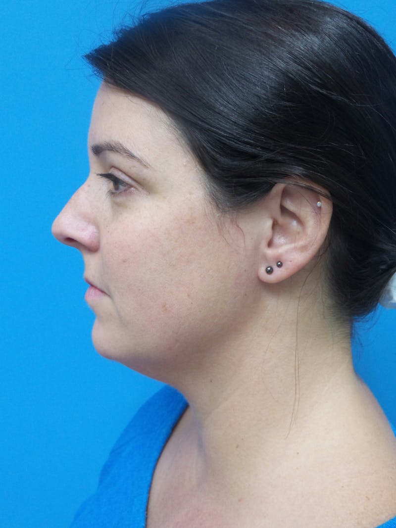 Rhinoplasty Before & After Gallery - Patient 191310 - Image 1