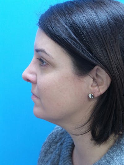 Rhinoplasty Before & After Gallery - Patient 191310 - Image 2