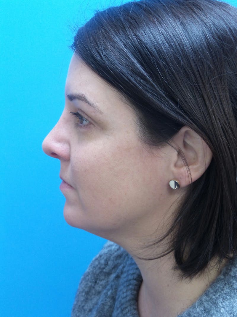 Rhinoplasty Before & After Gallery - Patient 191310 - Image 2