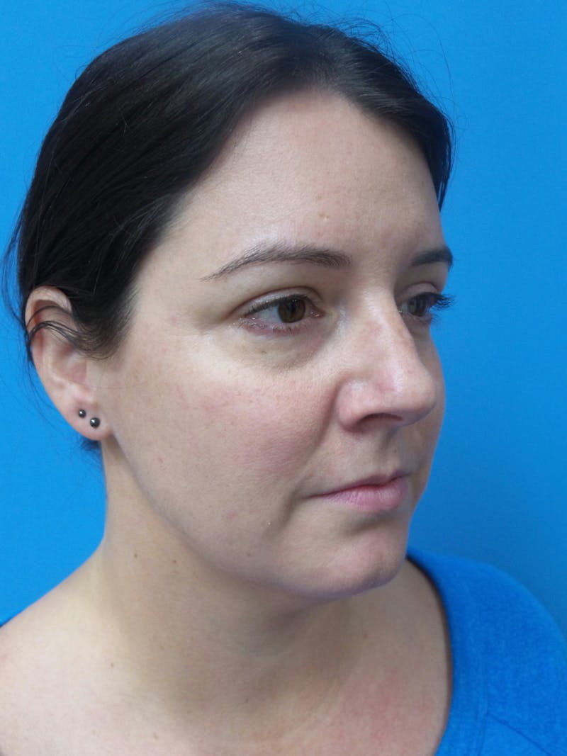 Rhinoplasty Before & After Gallery - Patient 191310 - Image 3
