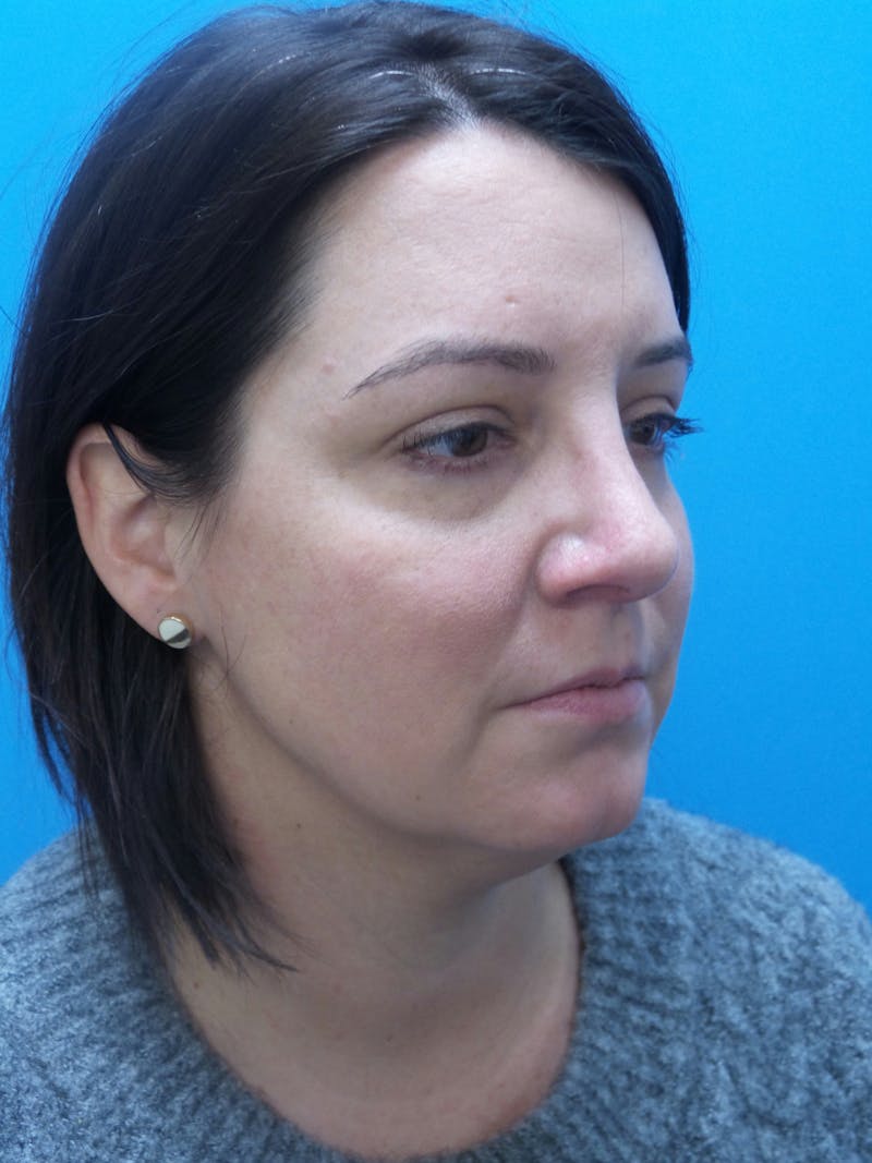 Rhinoplasty Before & After Gallery - Patient 191310 - Image 4