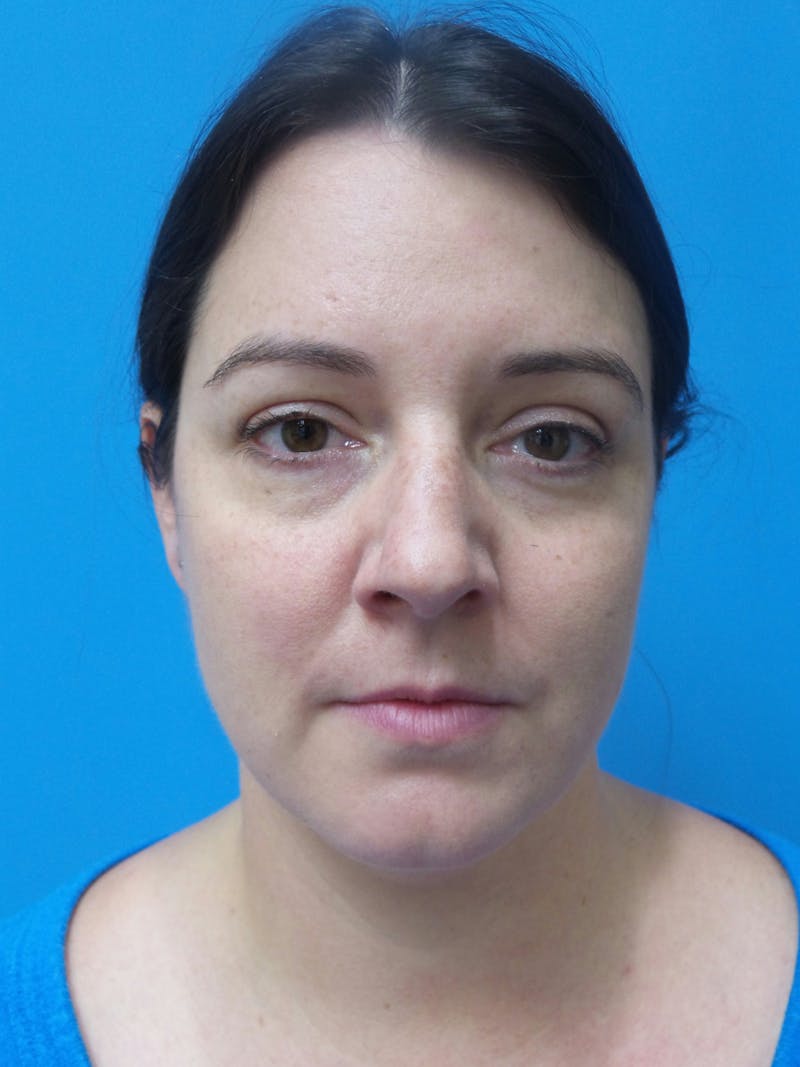Rhinoplasty Before & After Gallery - Patient 191310 - Image 5