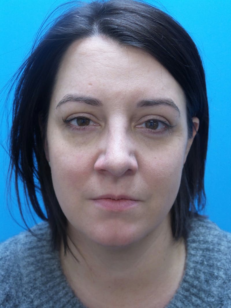 Rhinoplasty Before & After Gallery - Patient 191310 - Image 6